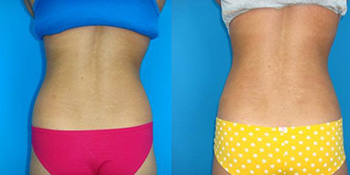 Gynecomastia Male
